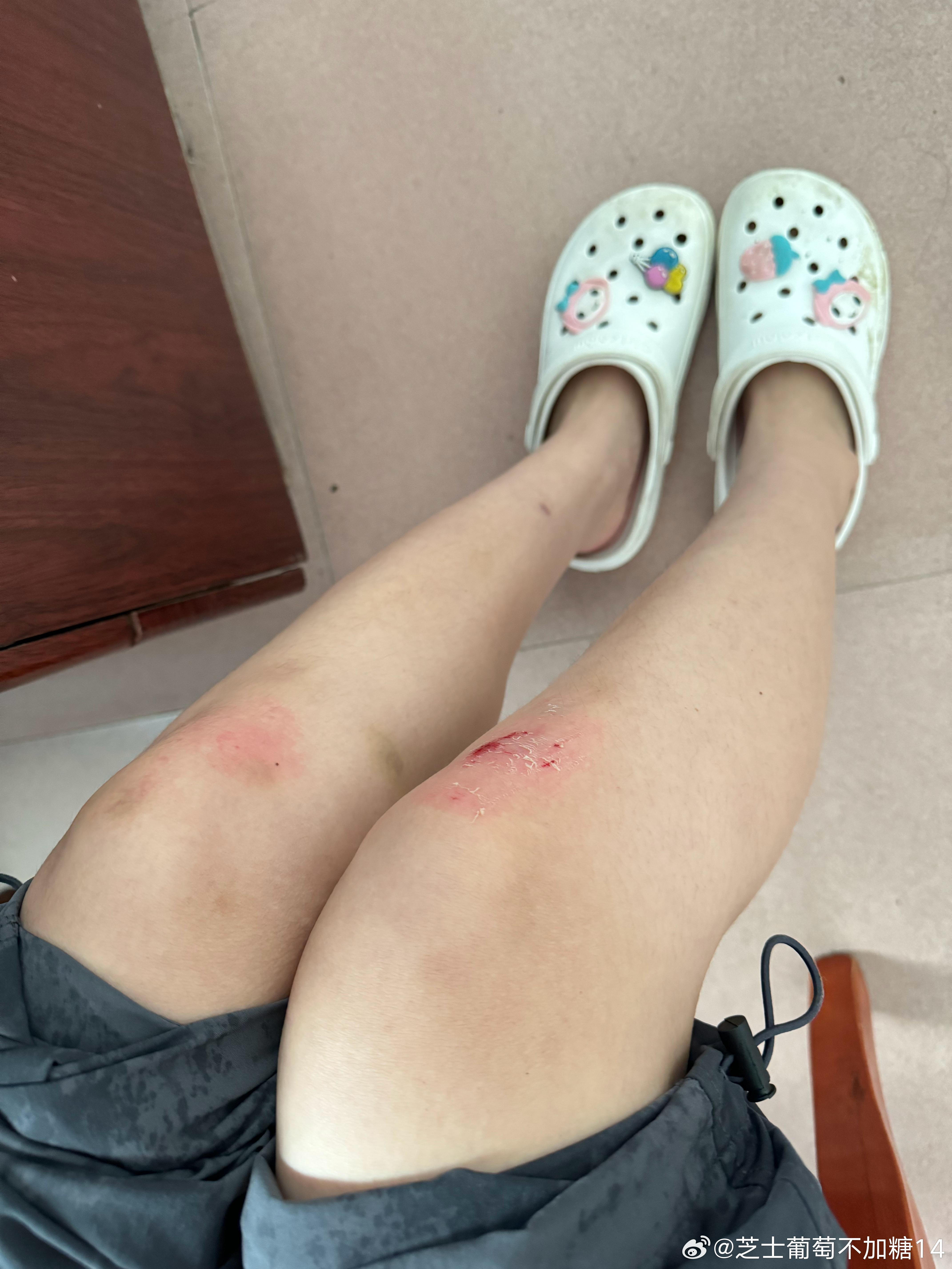 塔伊薩受傷最新進(jìn)展及恢復(fù)預(yù)測(cè)更新