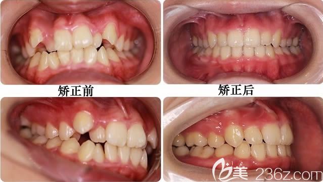 關(guān)于成人牙齒正畸價格的深度探討與解析